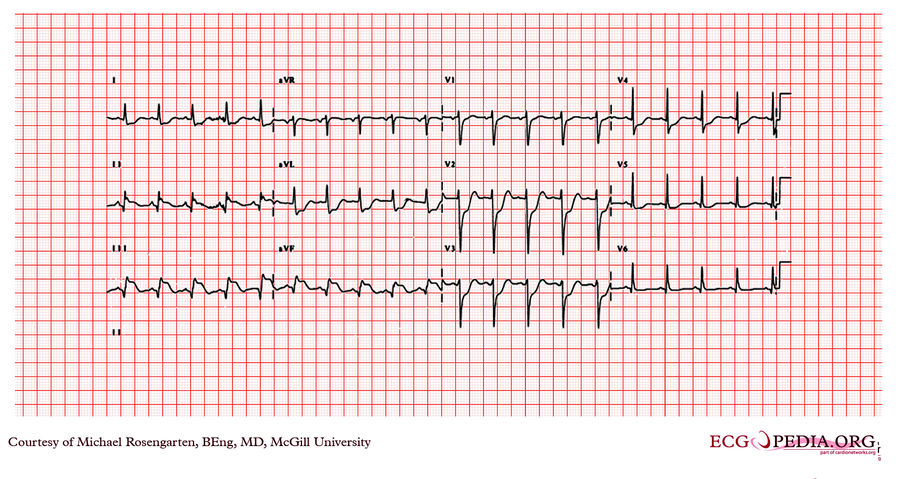 McGill Case 91 - ECGpedia