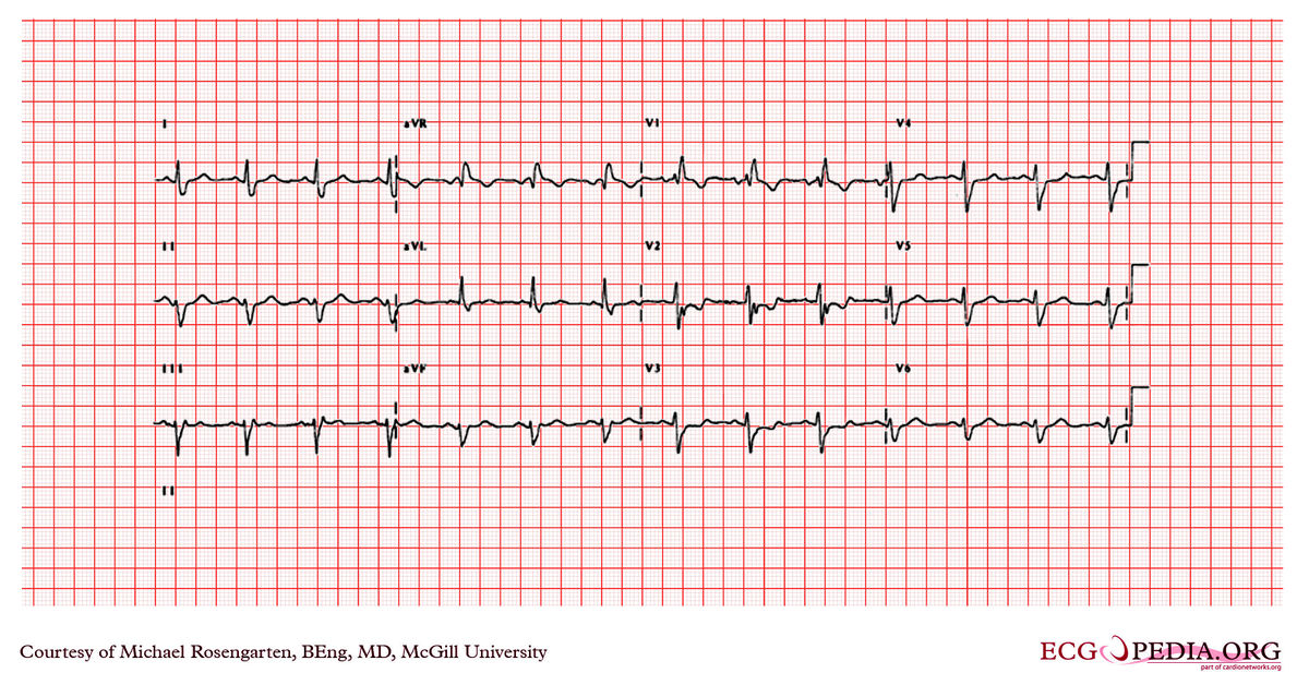 McGill Case 21 - ECGpedia