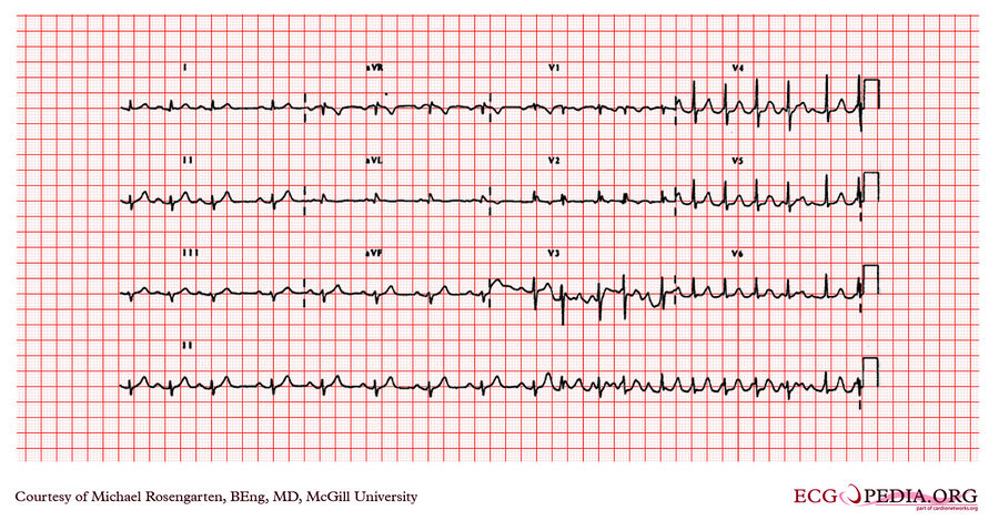 McGill Case 234 - ECGpedia