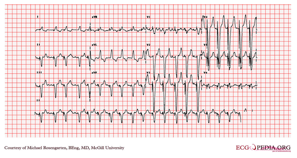 Mcgill Case 104 - Ecgpedia