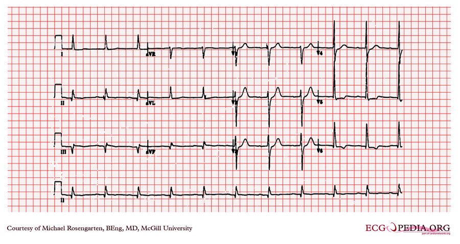 McGill Case 89 - ECGpedia