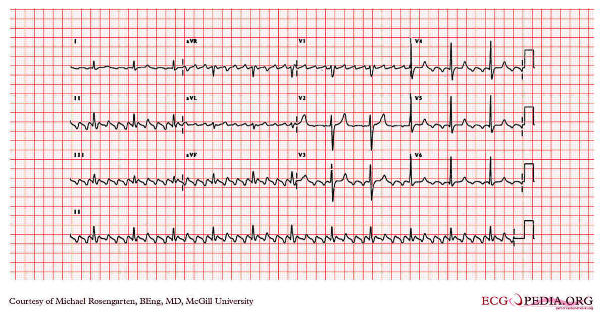 McGill Case 214 - ECGpedia