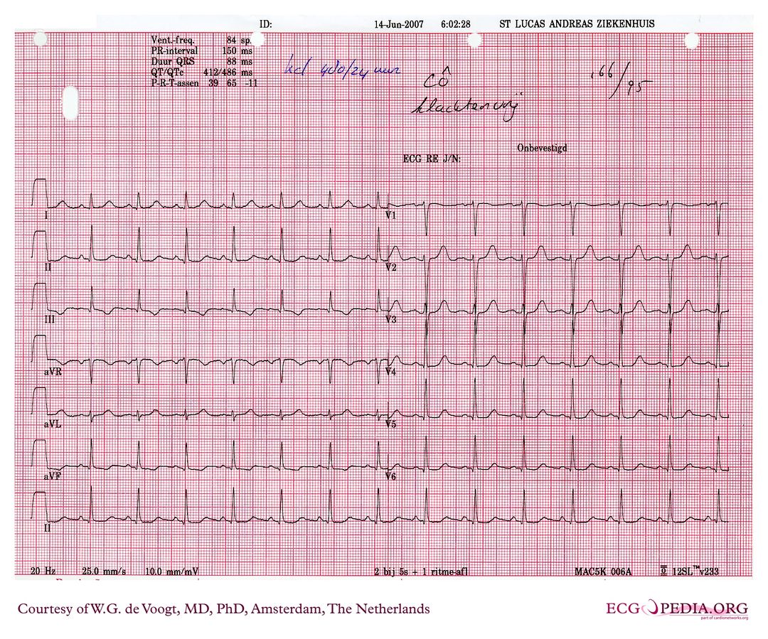 File:DVA0607.jpg - ECGpedia