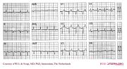 De Voogt ECG Archive - Myocardial Infarction - Inferior - ECGpedia