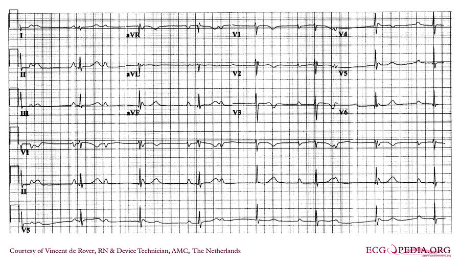 AMC Case 238 - ECGpedia