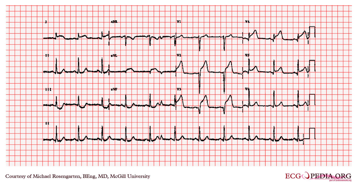 McGill Case 304 - ECGpedia