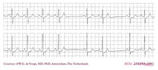 File:DVA0003.jpg - ECGpedia