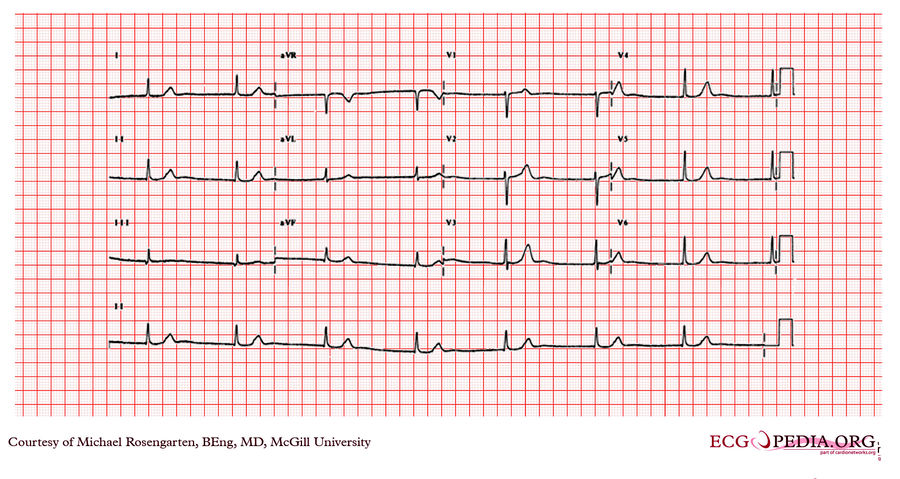 McGill Case 67 - ECGpedia