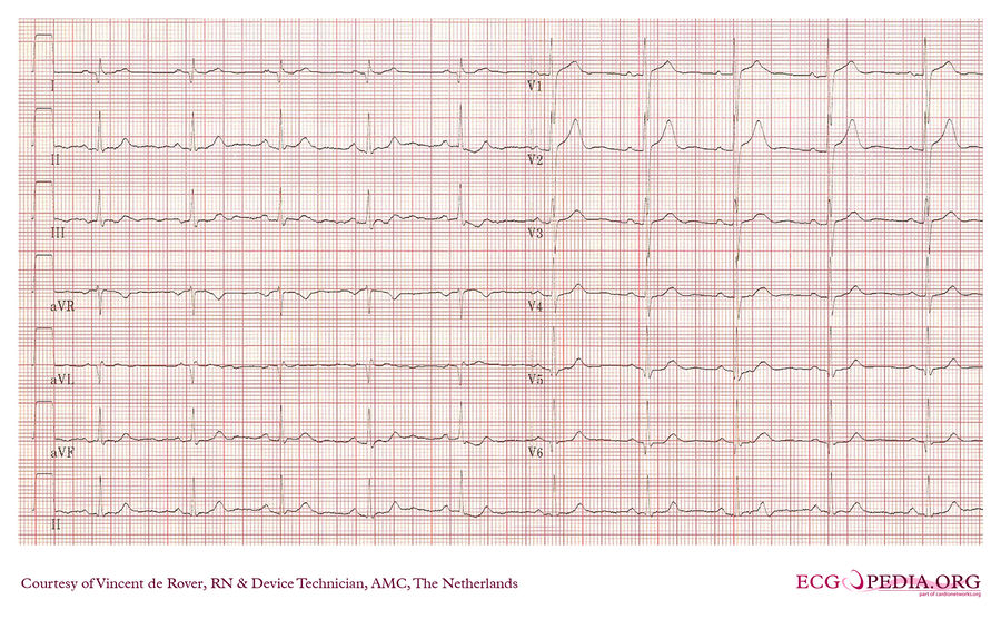 AMC Case 176 - ECGpedia