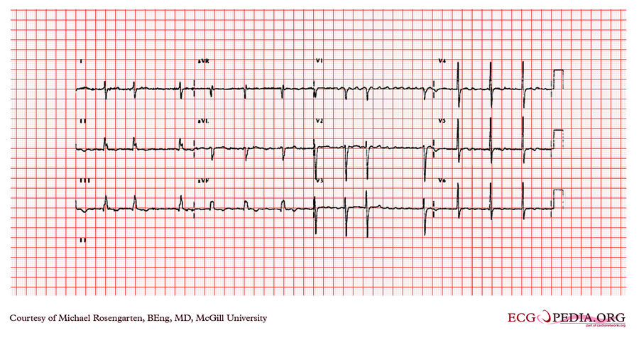 McGill Case 344 - ECGpedia