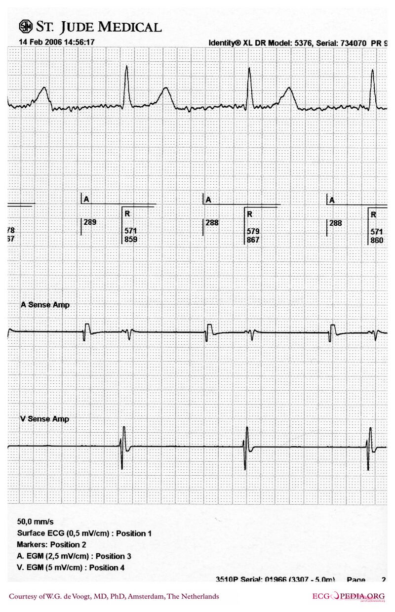 Filedva1433 Ecgpedia