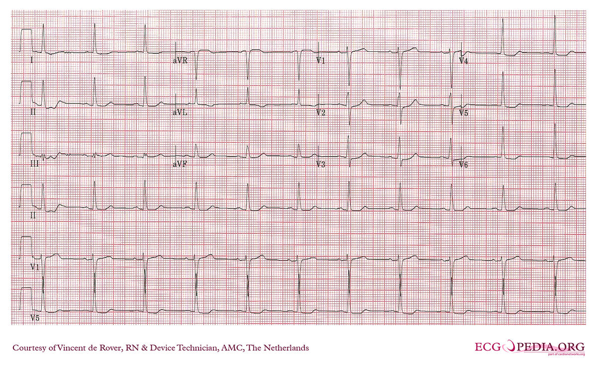 AMC Case 21 - ECGpedia