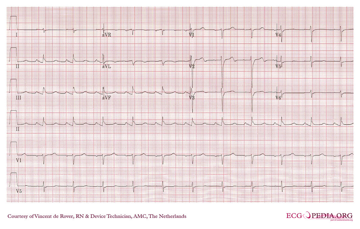 AMC Case 167 - ECGpedia