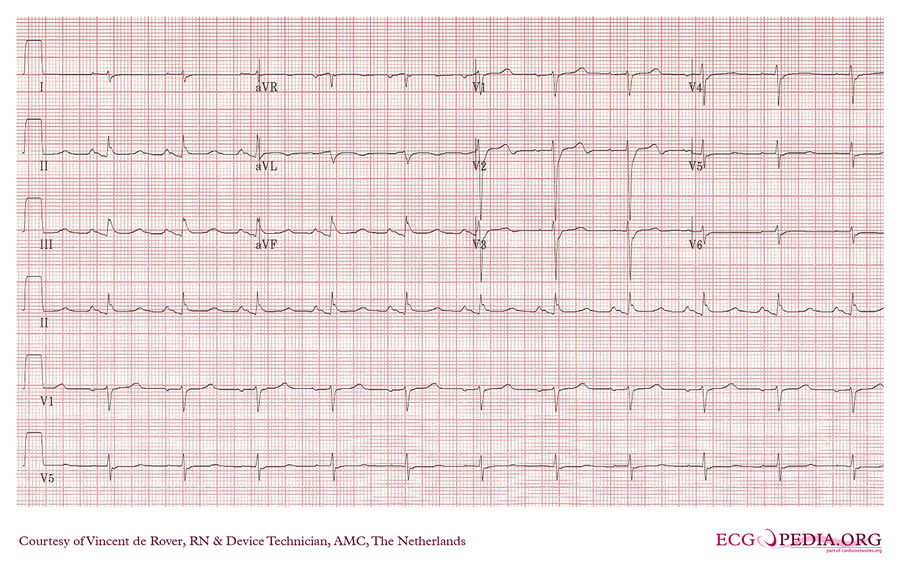 AMC Case 167 - ECGpedia