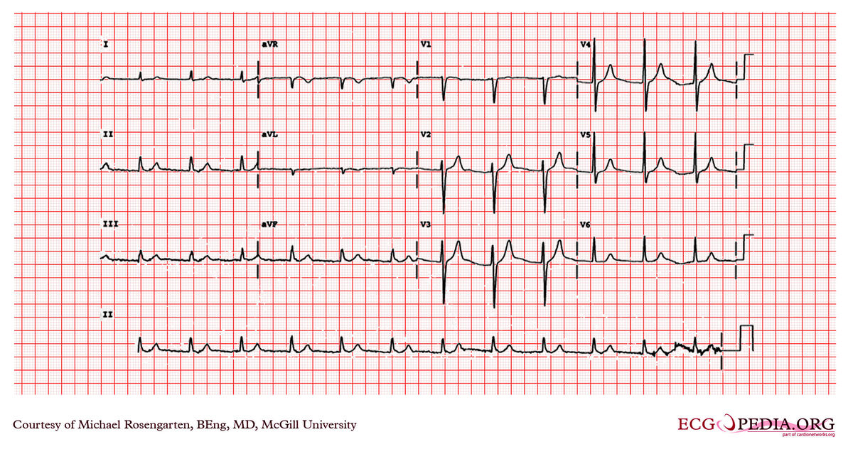 McGill Case 25 - ECGpedia