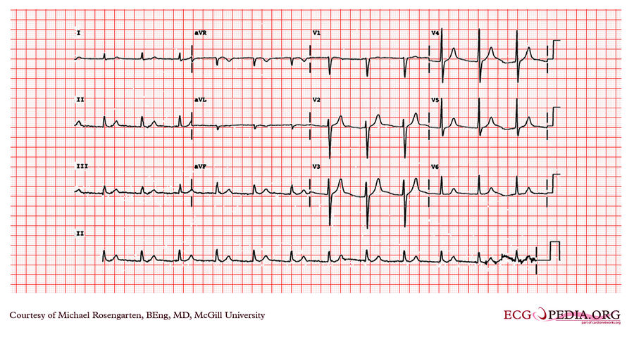 McGill Case 25 - ECGpedia