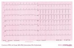 De Voogt ECG Archive - Supraventricular Rhythms - Atrial flutter - ECGpedia