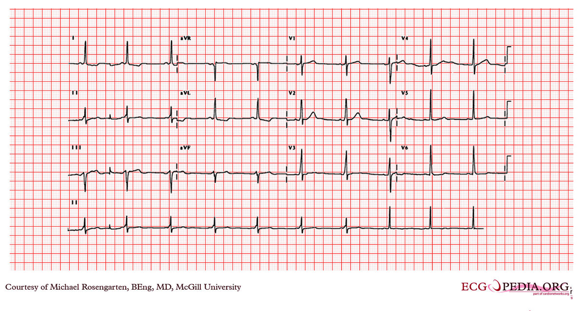 McGill Case 72 - ECGpedia