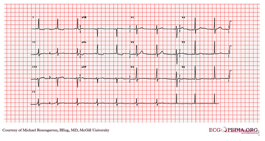 McGill Case 72 - ECGpedia