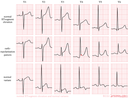 ST Morphology - ECGpedia