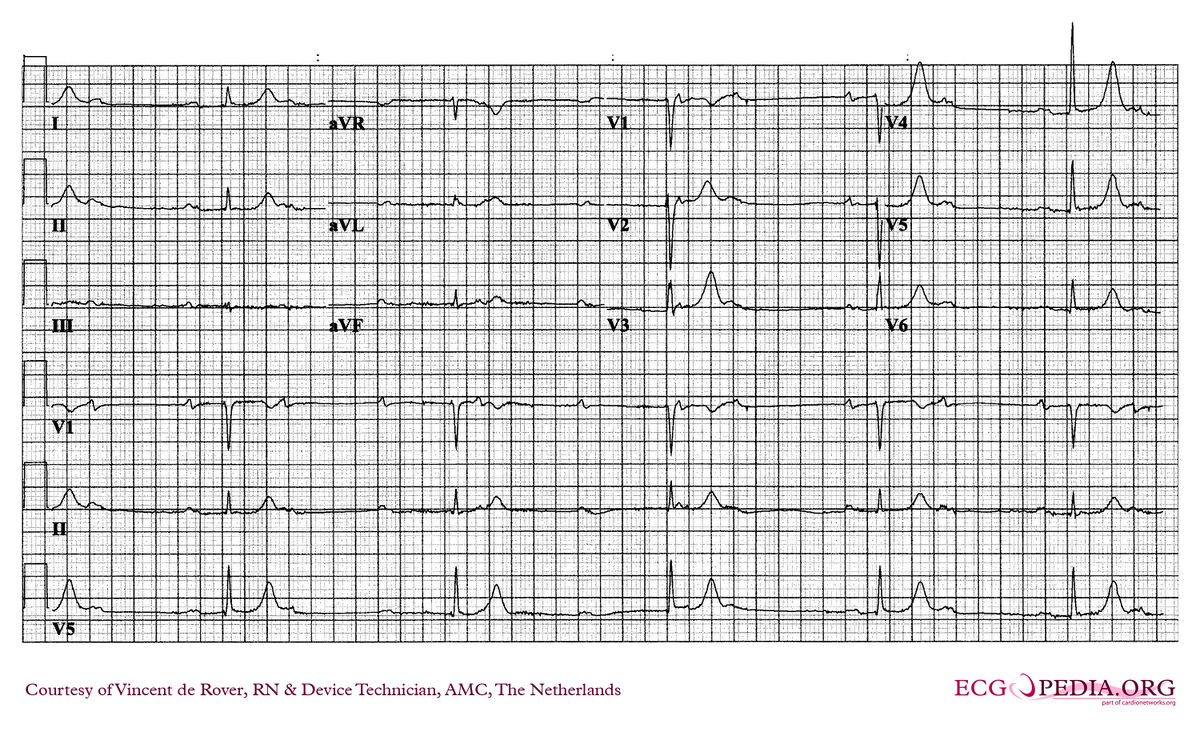 Amc Case 130 Ecgpedia