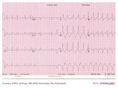 De Voogt ECG Archive - Supraventricular Rhythms - AF - ECGpedia