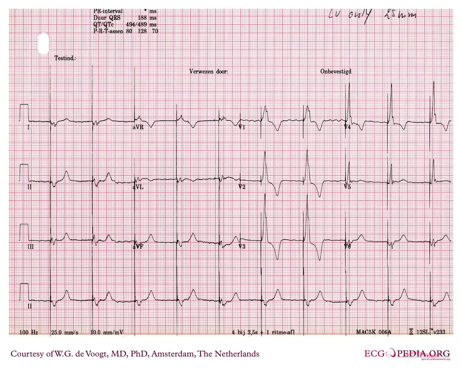 File:DVA0898.jpg - ECGpedia