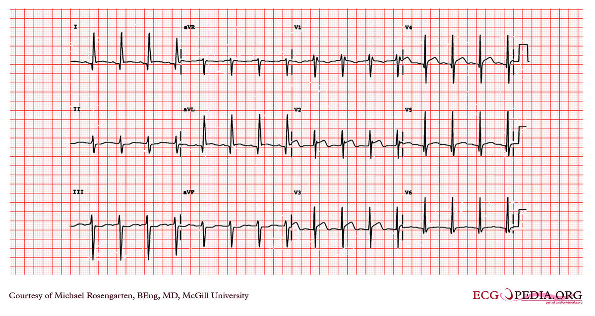 McGill Case 13 - ECGpedia