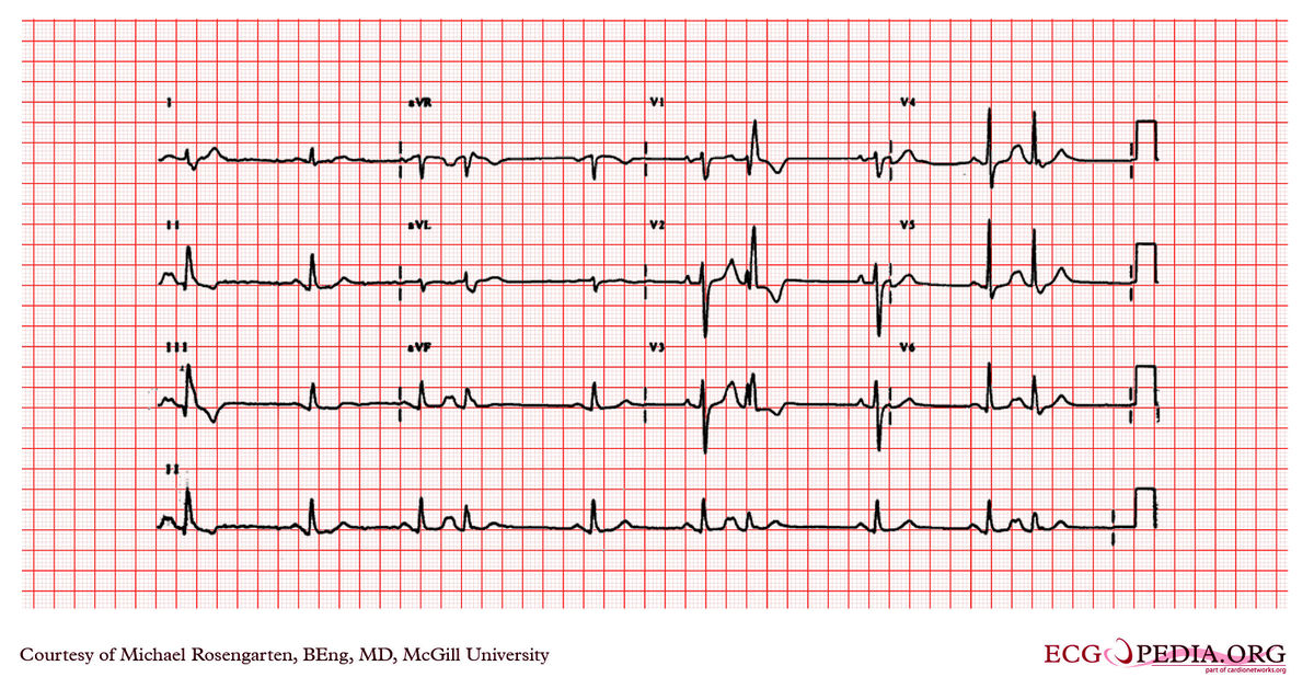 McGill Case 191 - ECGpedia