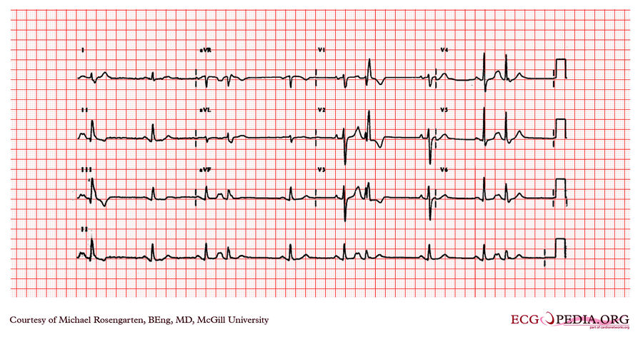 McGill Case 191 - ECGpedia