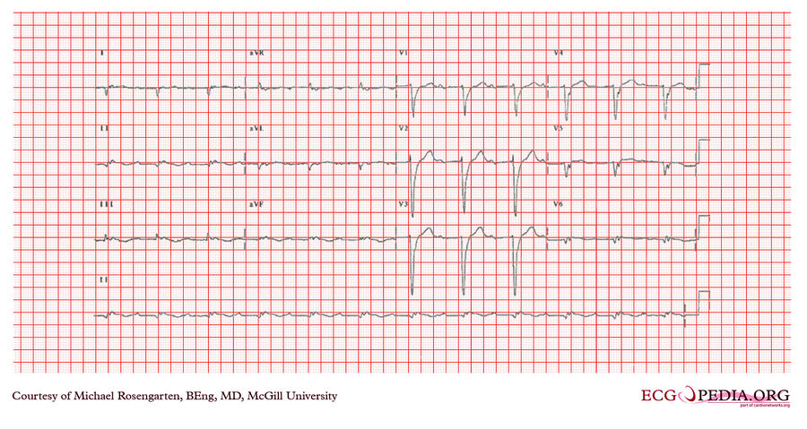 McGill Case 354 - ECGpedia