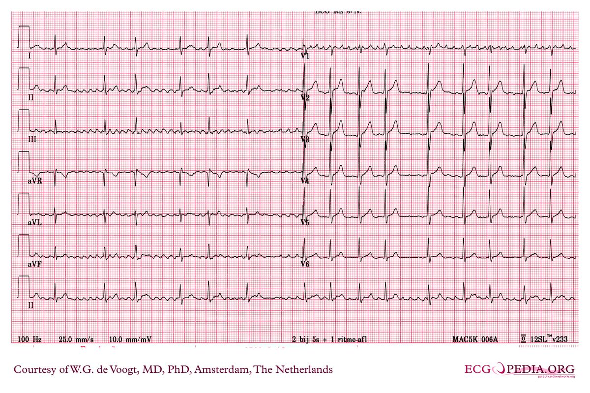 File:dva0181.jpg - Ecgpedia