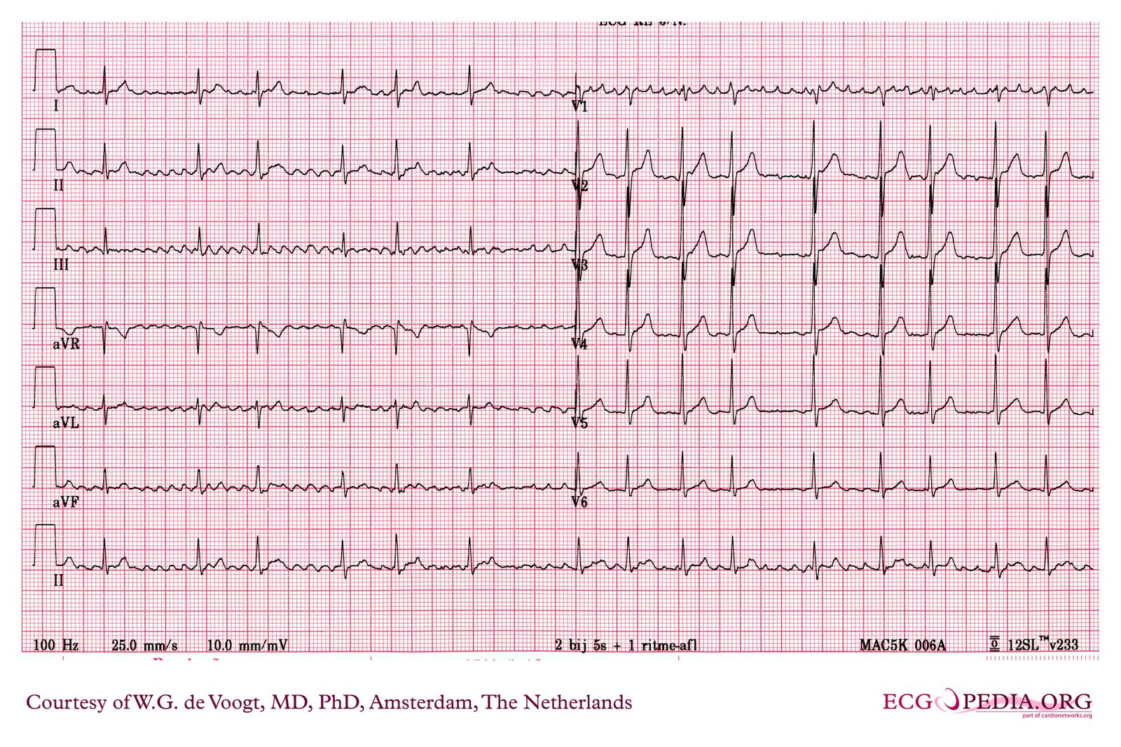 File:DVA0181.jpg - ECGpedia