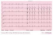 De Voogt ECG Archive - Supraventricular Rhythms - AF - ECGpedia