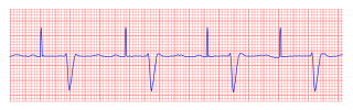 File:Ventricular noncapture.svg - ECGpedia