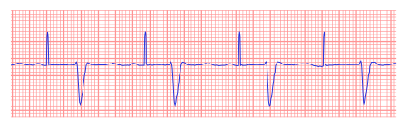 Pacemaker - ECGpedia