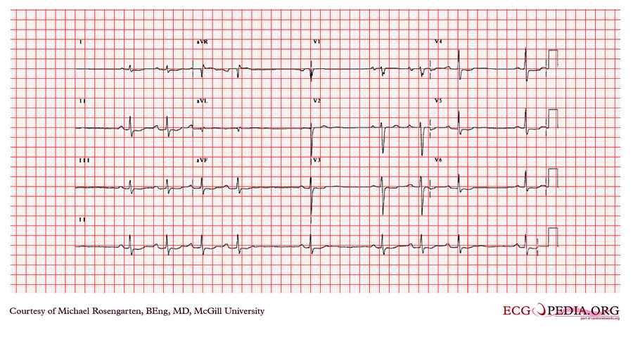 McGill Case 374 - ECGpedia