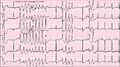 12-lead ECG of Torsades de Pointes (TdP) in a 56-year-old white female with a potassium of 2.4 mmol/L and a magnesium of 1.6 mg/dL.