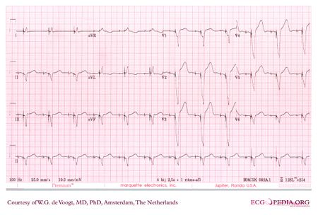 Pacemaker - ECGpedia