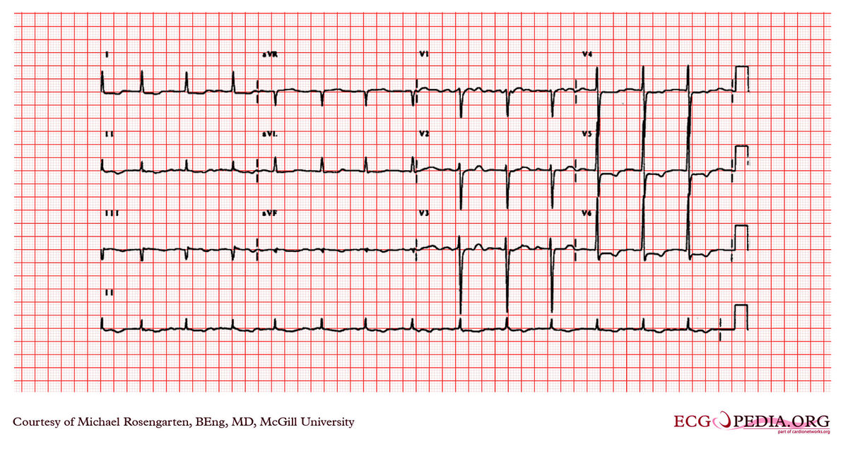 McGill Case 49 - ECGpedia