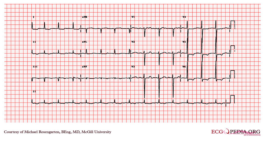 McGill Case 49 - ECGpedia