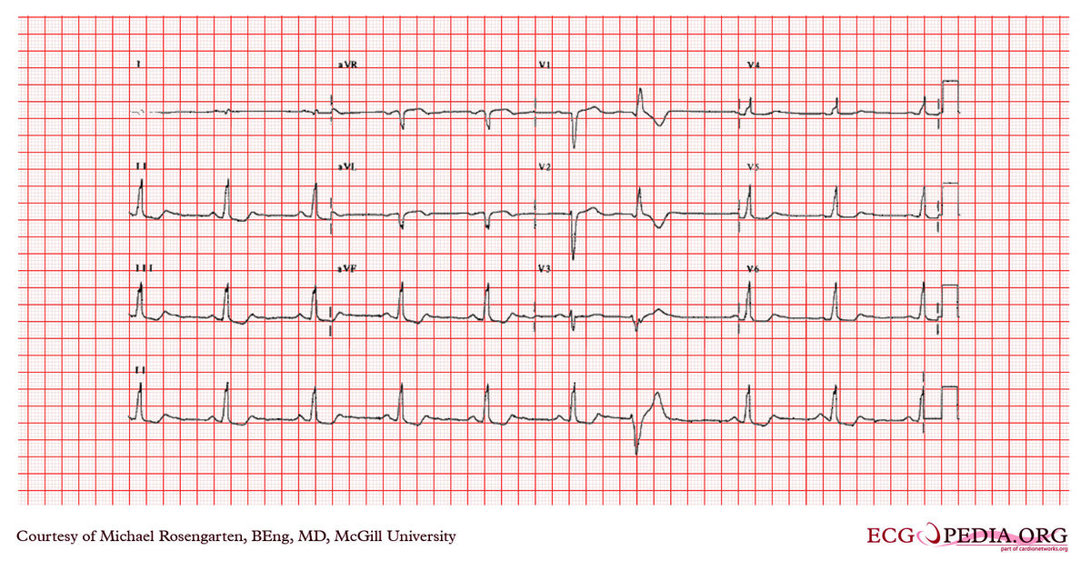 McGill Case 361 - ECGpedia