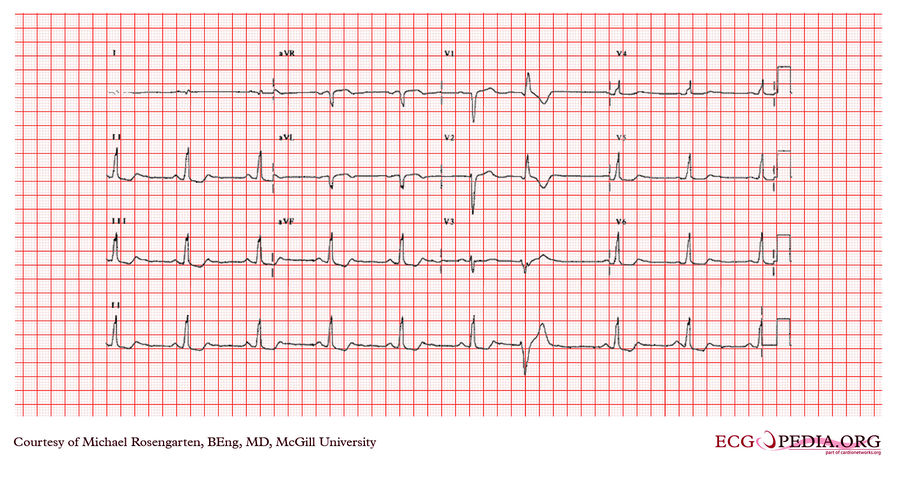 McGill Case 361 - ECGpedia