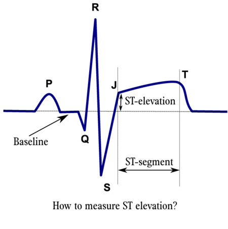 ST Morphology - ECGpedia