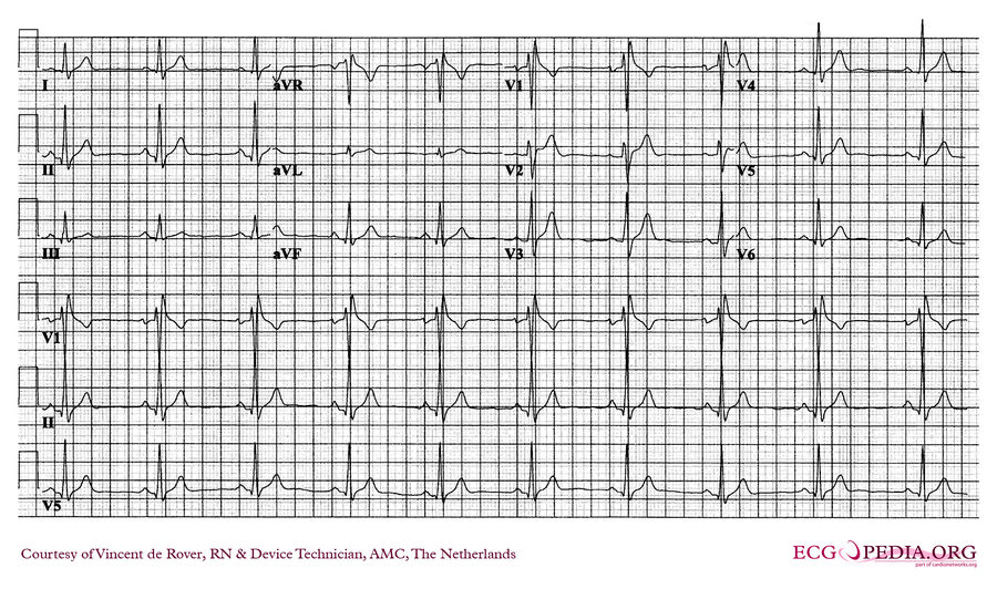 AMC Case 187 - ECGpedia