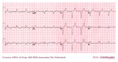 De Voogt ECG Archive - Intraventricular Conduction - ECGpedia