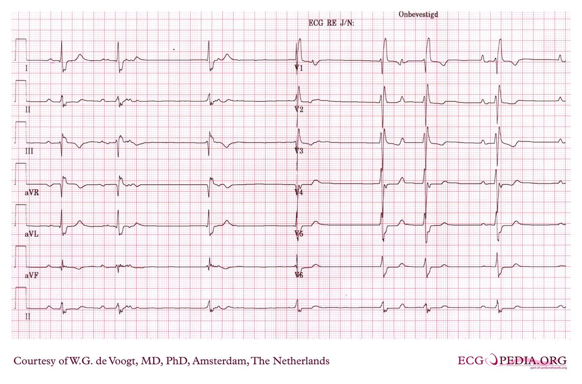 File:DVA0748.jpg - ECGpedia