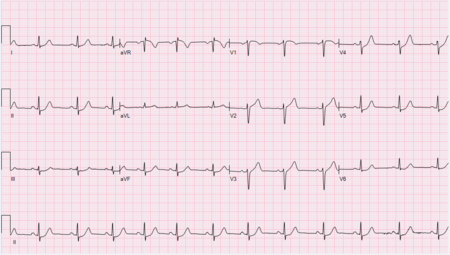 Eponymous ECG's - ECGpedia