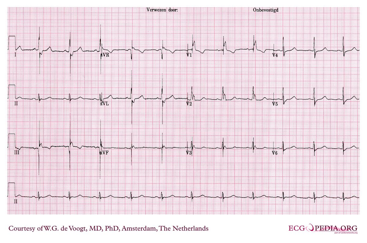 File:DVA1733.jpg - ECGpedia