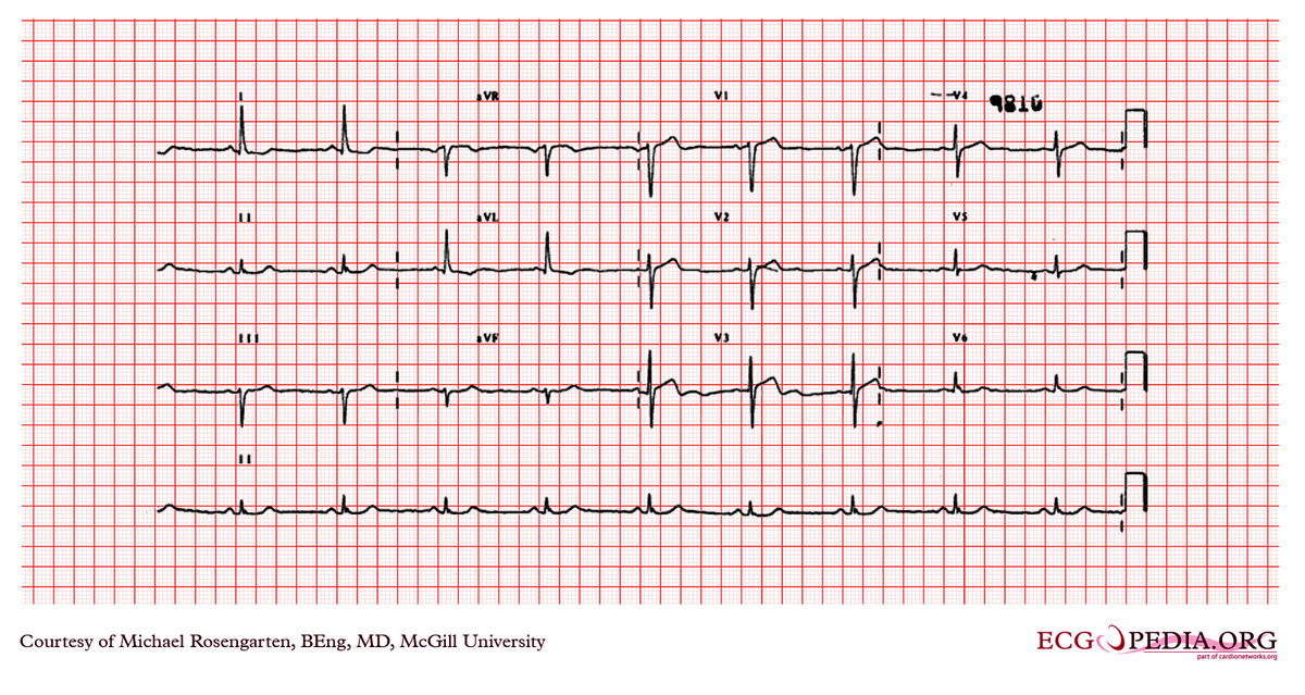 McGill Case 245 - ECGpedia